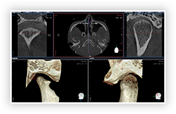 저선량 3D CT