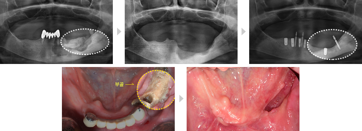 고난이도 임플란트 치료증례