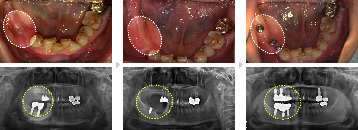 고난이도 임플란트 치료증례