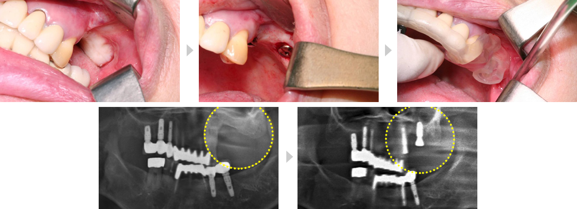 고난이도 임플란트 치료증례
