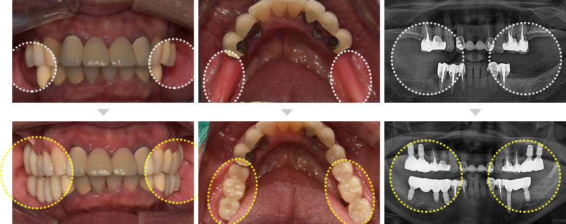 고난이도 임플란트 치료증례