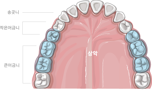 상악동 거상술이란?