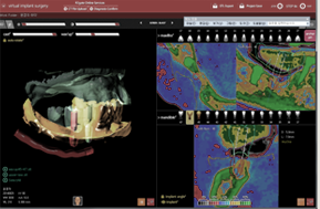3D 시뮬레이션을 통한 모이 시술