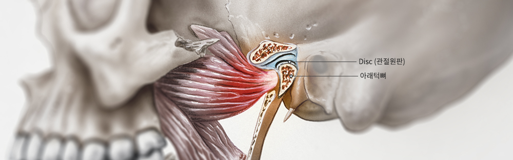 턱관절 장애란?