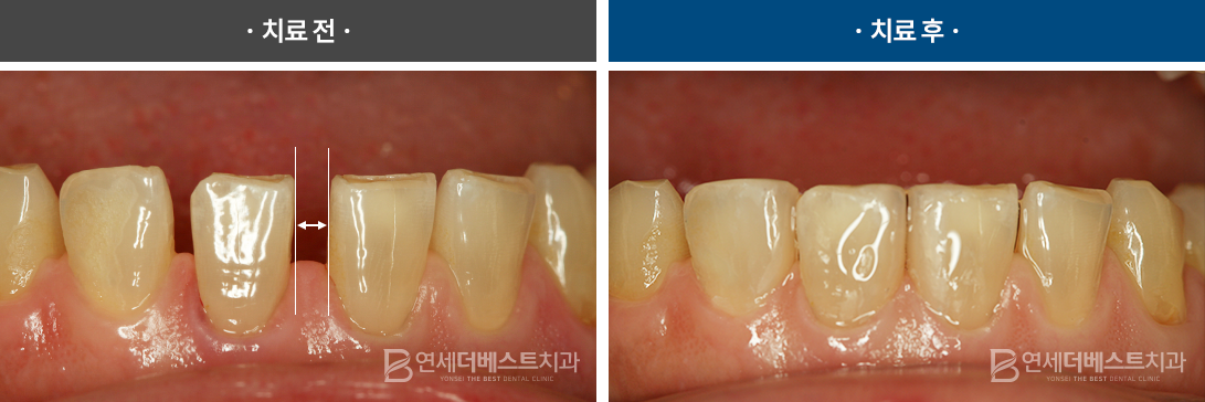 맞춤 라미네이트 치료 증례