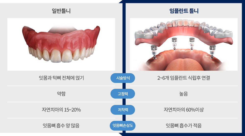 임플란트 틀니 차별점