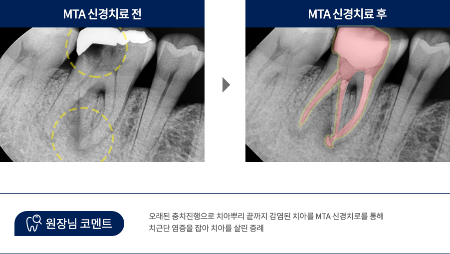 MTA 충전